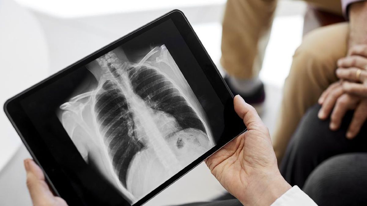 Pahami Penyebab Kanker Paru Serta Cara Tepat Diagnosis dan Pengobatannya