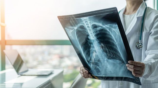 Indonesia menjadi negara ke-3 dengan kasus tuberkulosis (TB) terbanyak di dunia, dengan 824 ribu kasus dan 93 ribu di antaranya mengakibatkan kematian.