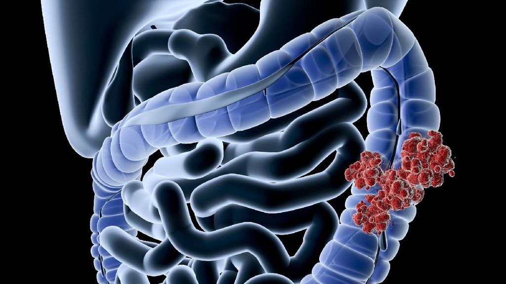 Gen Z Banyak Kena Kanker Usus Besar, Makanan Ini Jadi Biang Keroknya