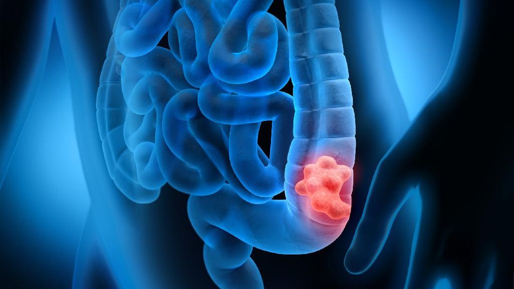 Dikira ISK, Pria 29 Tahun Ini Ternyata Kanker Usus