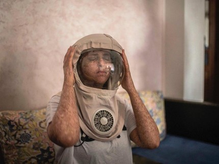 Wanita Idap Sakit Kulit Langka, 20 Tahun Tak Bisa Keluar Rumah Tanpa Helm Khusus