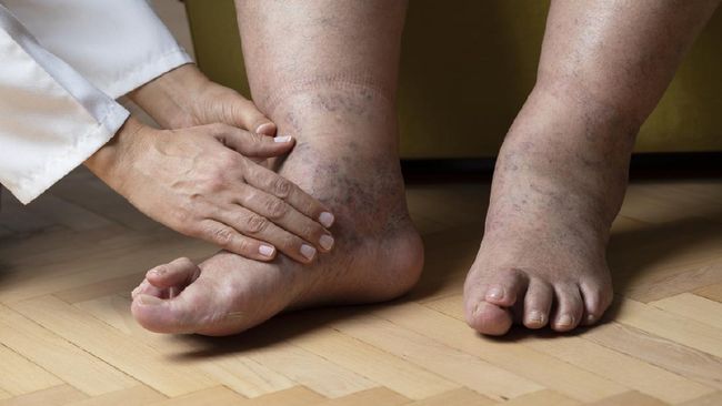 Awas, Ada 5 Penyakit Berbahaya yang Ditandai Kaki Bengkak Meski kaki bengkak sering dianggap biasa, tapi Anda tetap perlu berhati-hati. Ada beberapa penyakit yang ditandai dengan kaki bengkak.