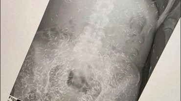 Heboh Penampakan Ratusan Susuk di Tubuh Wanita Berusia 55 Tahun