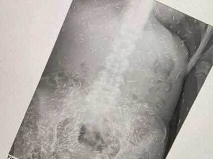 5 Fakta di Balik Viral Wanita Pakai Ratusan Susuk dalam Tubuh