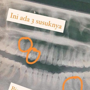 Fakta di Balik Viral Penampakan Ratusan Susuk di Tubuh Wanita 55 Tahun