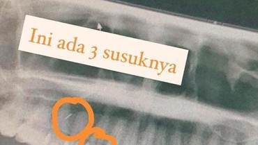 Fakta di Balik Viral Penampakan Ratusan Susuk di Tubuh Wanita 55 Tahun
