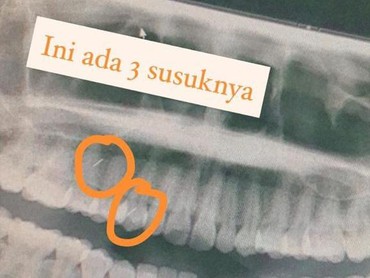 Fakta di Balik Viral Penampakan Ratusan Susuk di Tubuh Wanita 55 Tahun