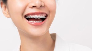 Cara Merawat Kebersihan Gigi Berkawat, Yuk Terapkan