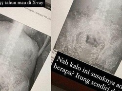 Heboh Susuk Terdeteksi Xray, Ini 5 Pantangan Makan Bagi Pemakai Susuk