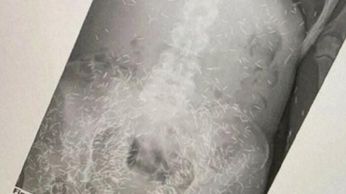 Gimana dan Apa Sebenarnya 'Susuk'? Yuk Ketahui Faktanya