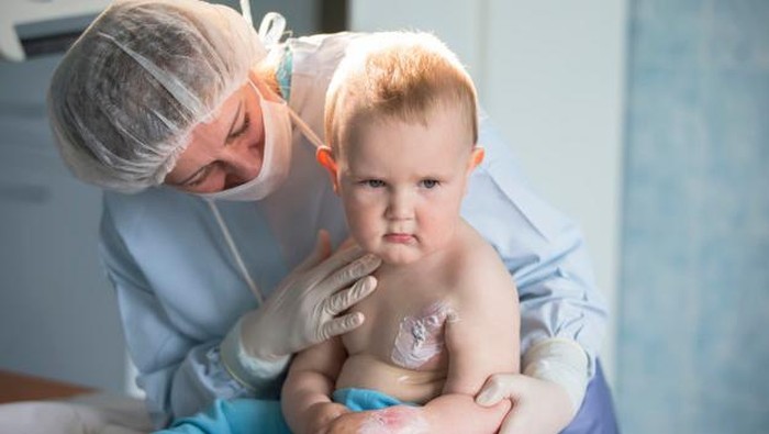 Orangtua Wajib Tahu, Ini Langkah Pertolongan Pertama untuk Luka Bakar Pada Anak