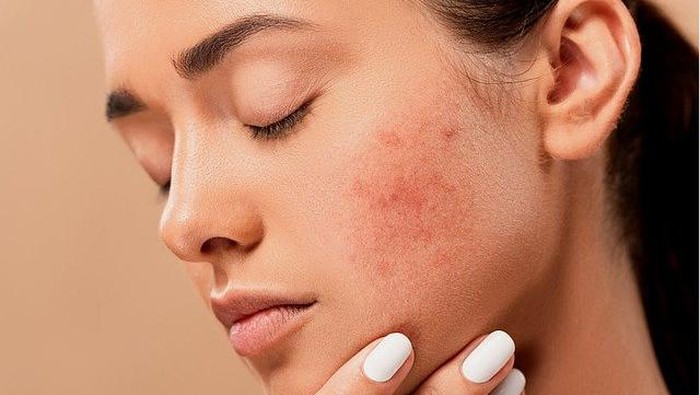 Letak Jerawat Bisa Tunjukan Arti Penyakit, Lho!