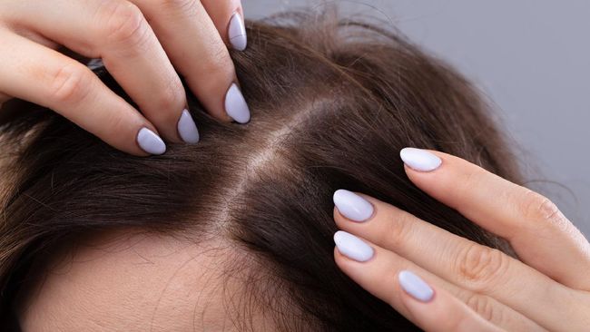 Jerawat bisa timbul di mana saja, termasuk di garis rambut. Berikut cara mencegahnya.