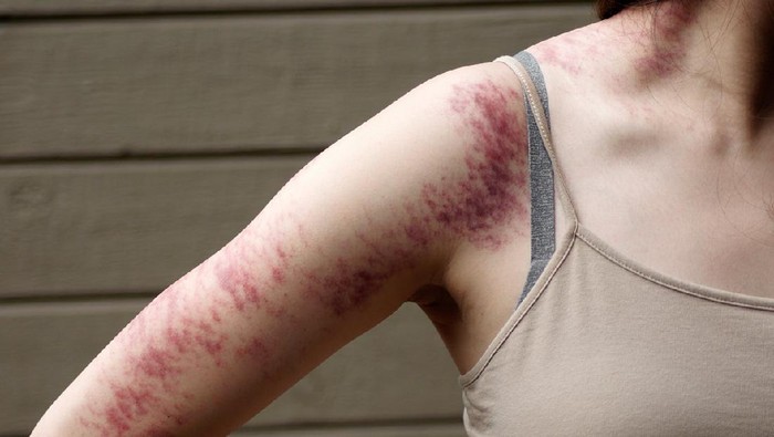 Sembuhkan Masuk Angin dengan Teknik Kerokan, Aman atau Berbahaya?