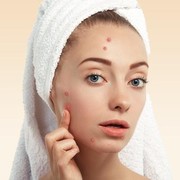 Ampuh Banget! 4 Bahan Alami Ini Hilangkan Bekas Jerawat Membandel