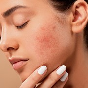 Bahan Alami untuk Menghilangkan Fungal Acne