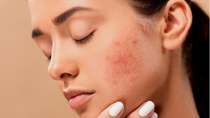 Bahan Alami untuk Menghilangkan Fungal Acne