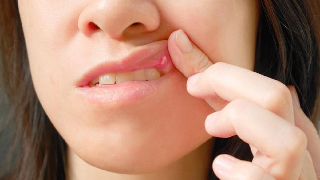 Sariawan saat puasa Ramadhan? Ahli menjelaskan ada beberapa penyebab termasuk kebiasaan buruk menggigiti area mulut dan bibir.