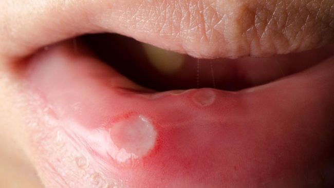 Terdapat sejumlah cara yang dapat dilakukan untuk mencegah sariawan di bibir dan rongga mulut.