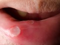 5 Cara Mencegah Sariawan di Bibir dan Rongga Mulut