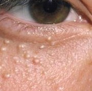 Apa Itu Milia dan Bagaimana Mencegahnya?