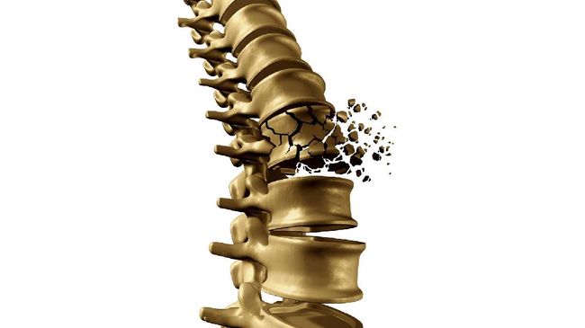 Osteoporosis merupakan salah satu penyebab tulang lemah, keropos, dan rapuh. Ada berbagai gejala tulang keropos yang bisa diwaspadai.