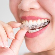 Invisible Teeth Aligner Makin Nge-trend, yuk Intip Beberapa Referensinya!