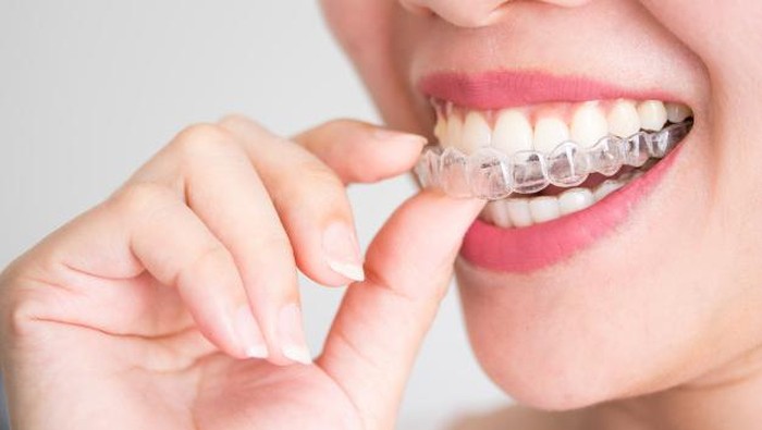 Invisible Teeth Aligner Makin Nge-trend, yuk Intip Beberapa Referensinya!
