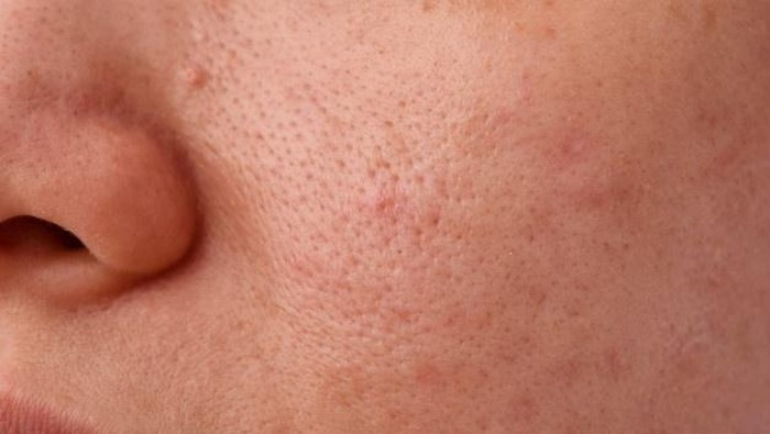 Kesal dengan Beruntusan? Ini Cara Tepat Mengatasinya!