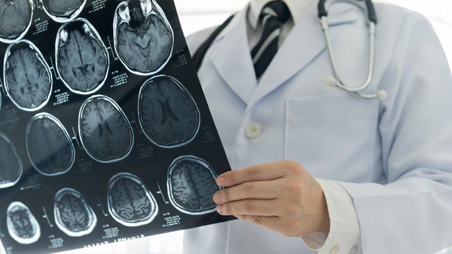 Stres yang tidak dikelola dengan baik dapat menyebabkan stroke. Oleh karena itu, penting bagi tubuh untuk selalu mengelola stres.