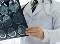 Stres yang Tidak Ditangani Bisa Sebabkan Stroke