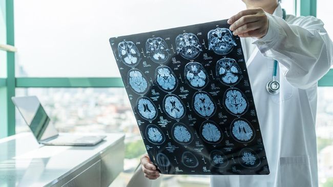 Kini, anak muda juga bisa terserang stroke. Kira-kira, apa saja kebiasaan yang membuat stroke di usia muda?