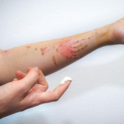 Gak Pede karena Bekas Luka? Cek Cara Menghilangkan Bekas Luka Ini!