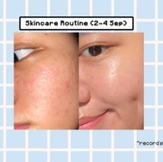 Coba Skincare Routine ala Youtuber Ini, Bruntusan Sembuh dalam 3 Hari!