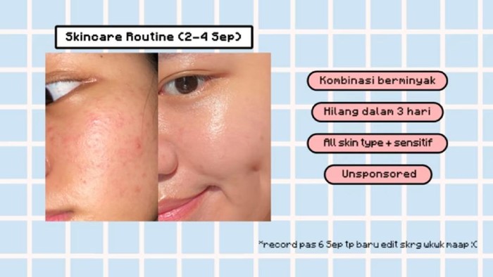 Coba Skincare Routine ala Youtuber Ini, Bruntusan Sembuh dalam 3 Hari!