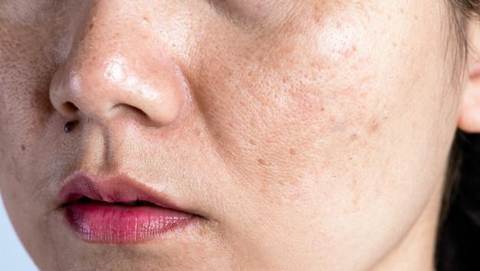 8 Faktor yang Menyebabkan Pori-pori Wajah Jadi Besar