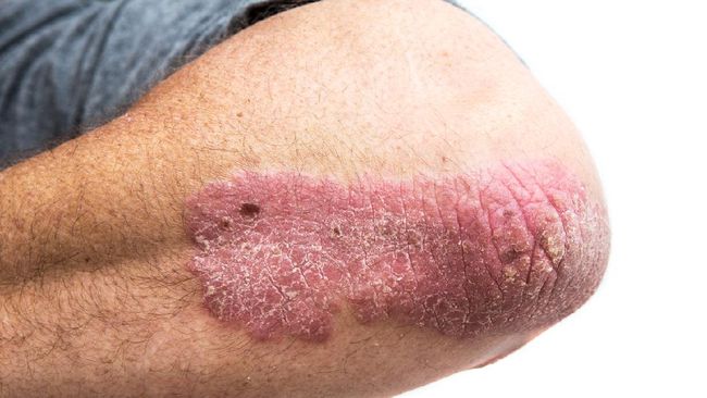 Psoriasis adalah penyakit kulit yang menyebabkan bercak merah bersisik dan gatal. Paling sering terjadi di bagian tubuh seperti lutut, siku, dan kulit kepala.
