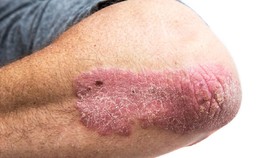 Mengenal Psoriasis, Penyakit Kulit yang Diderita LeAnn Rimes