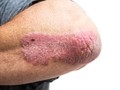 Mengenal Psoriasis, Penyakit Kulit yang Diderita LeAnn Rimes