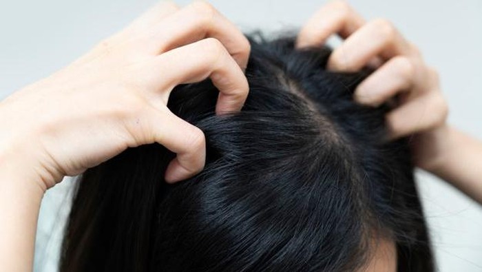 Jangan Salah! Ini Tips Jitu Mengatasi Kutu Rambut