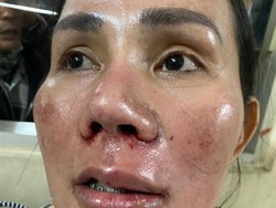 Mantan Manajer Lucinta Luna Bonyok Dikeroyok Orang Tak Dikenal