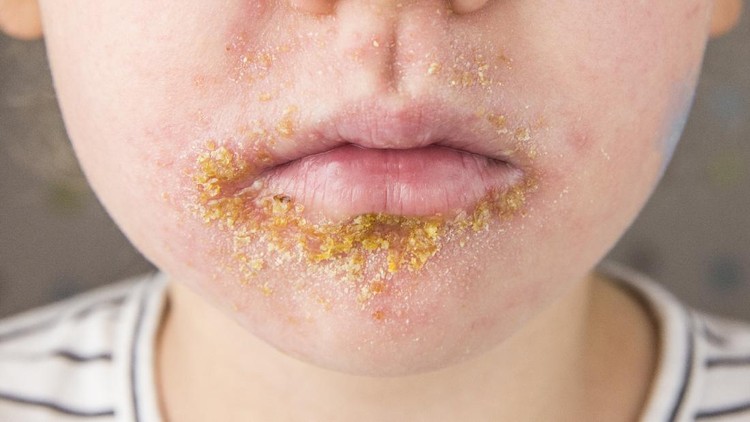 Impetigo Bulosa 5 year old child with Impetigo (nonbullous impetigo) witch is is a bacterial infection that involves the superficial skin. Yellow scabs on infected area.