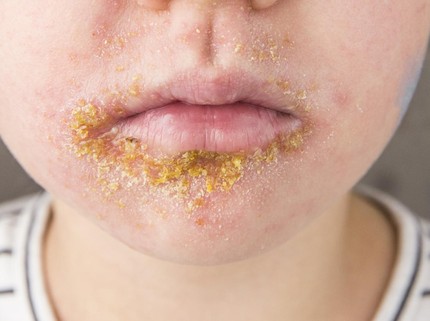 Kenali Impetigo Bulosa, Infeksi Bakteri yang Sering Menyerang Kulit Balita