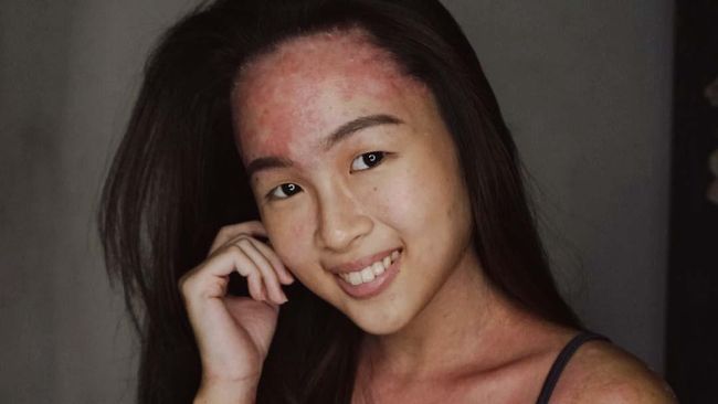 Kisah Chiara 12 Tahun Hidup Dengan Psoriasis
