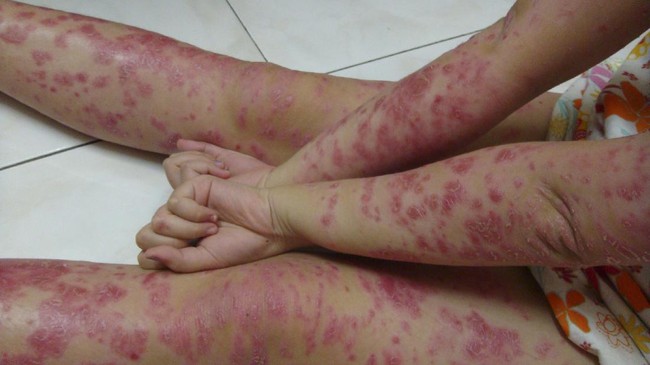 Pandemi  Covid-19 juga memicu kambunya penyakit autoimun kulit. Berikut tiga penyakit autoimun kulit yang sering kambuh saat pandemi.