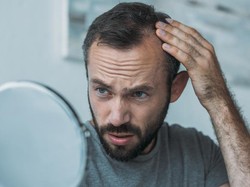Kopi Bisa Atasi Rambut Rontok Pada Pria, Begini Caranya