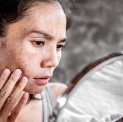 Penyebab Flek Hitam dan Cara Menghilangkannya