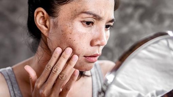 Penyebab Flek Hitam dan Cara Menghilangkannya