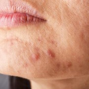 Rajin Skincare-an Kulit Tetep Breakout? Jangan-jangan karena Makanan Ini