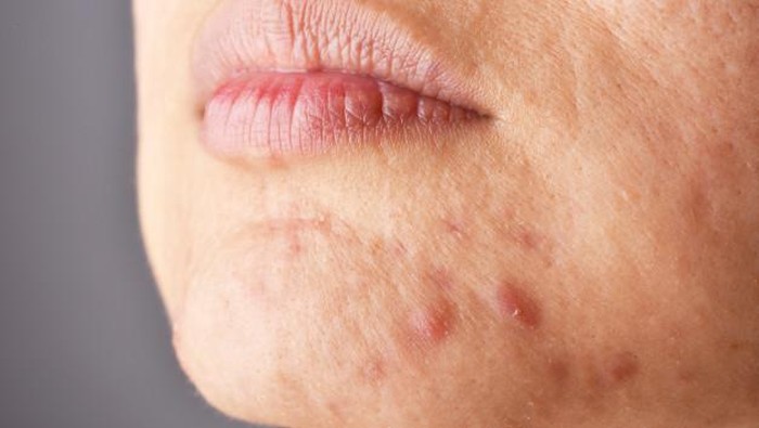 Rajin Skincare-an Kulit Tetep Breakout? Jangan-jangan karena Makanan Ini